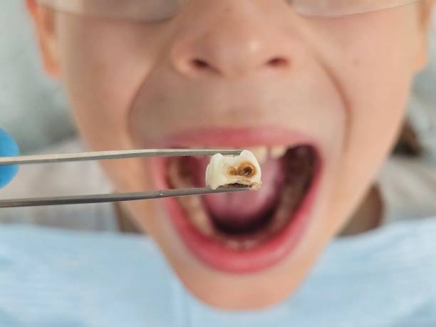 Best Emergency Tooth Extraction in Burgin, KY